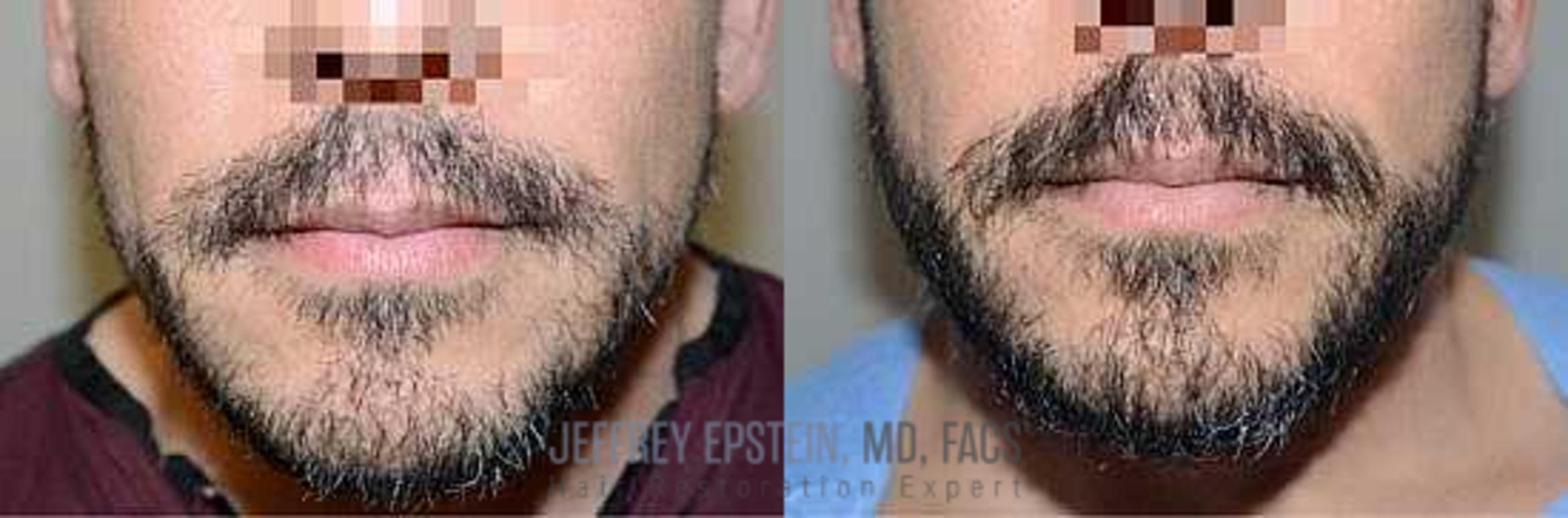 Before & After Beard Transplant Case 397 View 2 View in Miami, FL