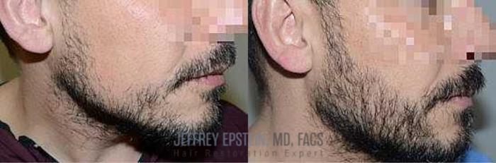 Before & After Beard Transplant Case 397 View 3 View in Miami, FL