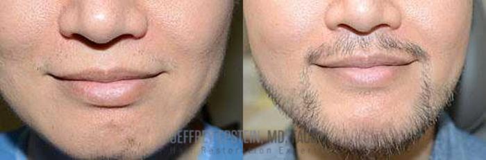 Before & After Beard Transplant Case 399 View 1 View in Miami, FL
