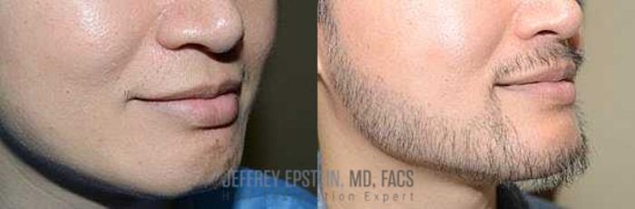 Before & After Beard Transplant Case 399 View 2 View in Miami, FL