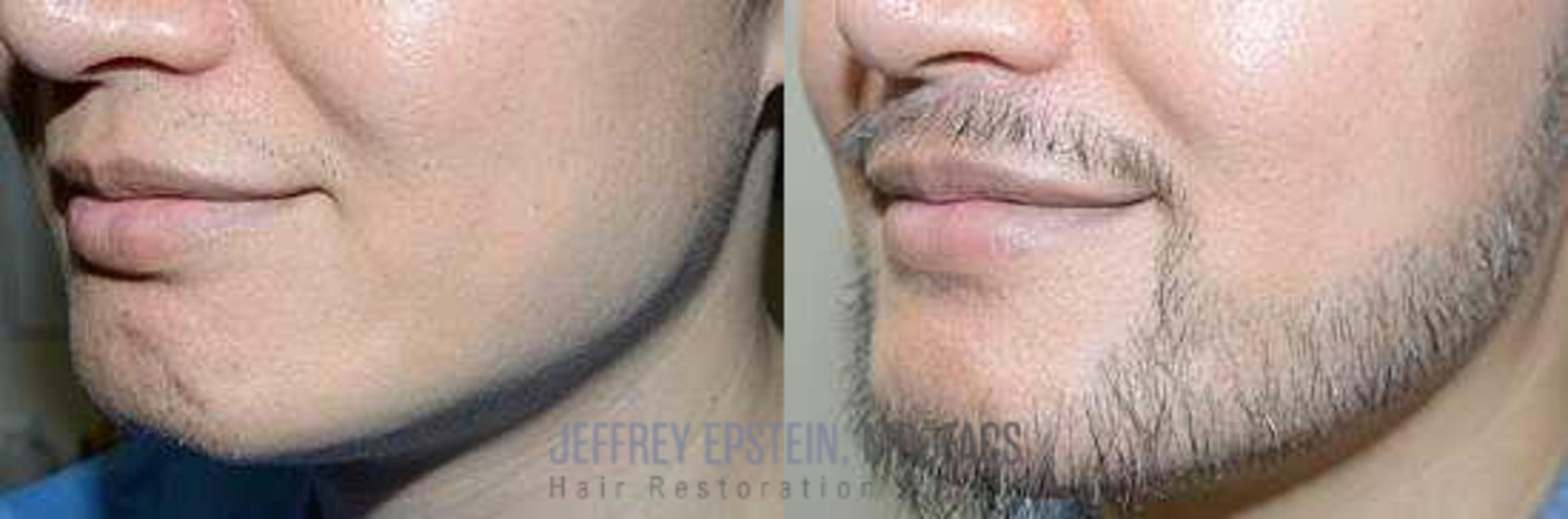 Before & After Beard Transplant Case 399 View 3 View in Miami, FL