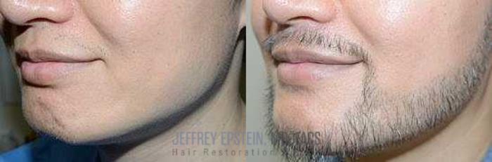 Before & After Beard Transplant Case 399 View 3 View in Miami, FL