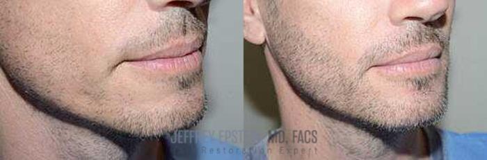 Before & After Beard Transplant Case 400 View 1 View in Miami, FL