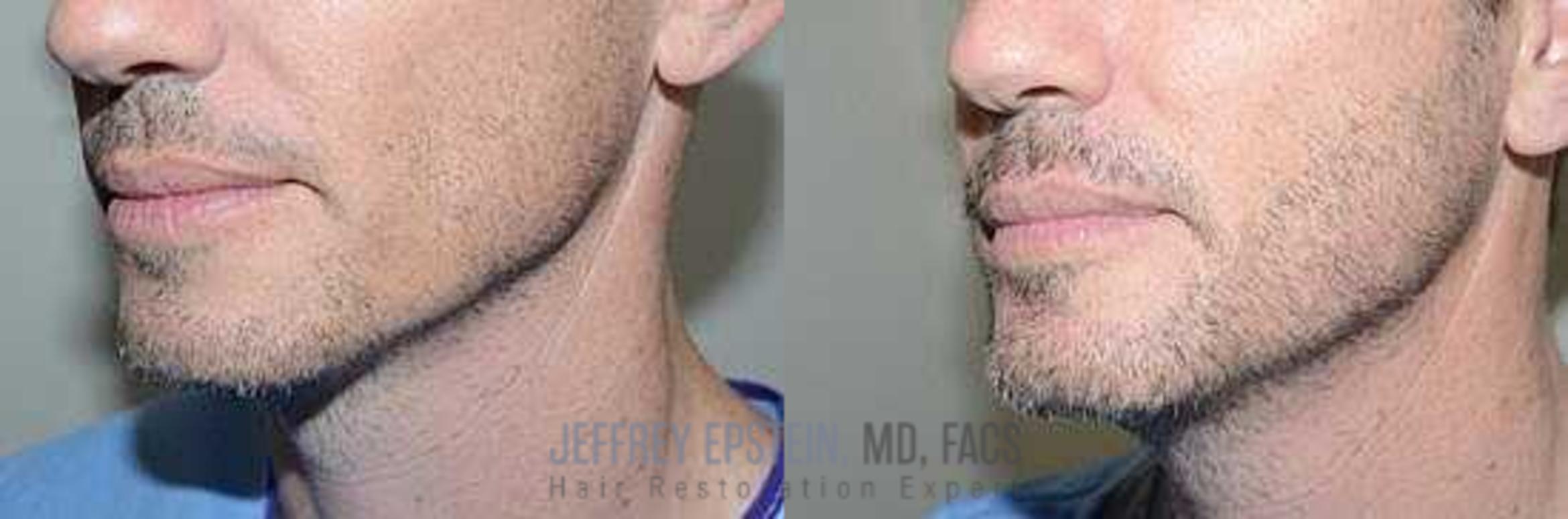 Before & After Beard Transplant Case 400 View 2 View in Miami, FL