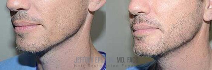 Before & After Beard Transplant Case 400 View 2 View in Miami, FL