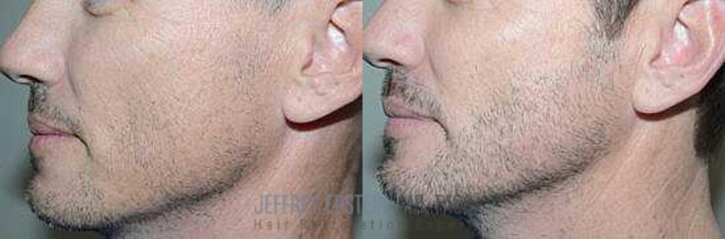 Before & After Beard Transplant Case 400 View 3 View in Miami, FL