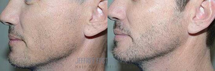 Before & After Beard Transplant Case 400 View 3 View in Miami, FL