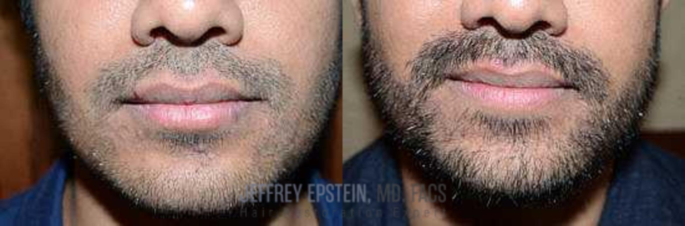 Before & After Beard Transplant Case 401 View 1 View in Miami, FL