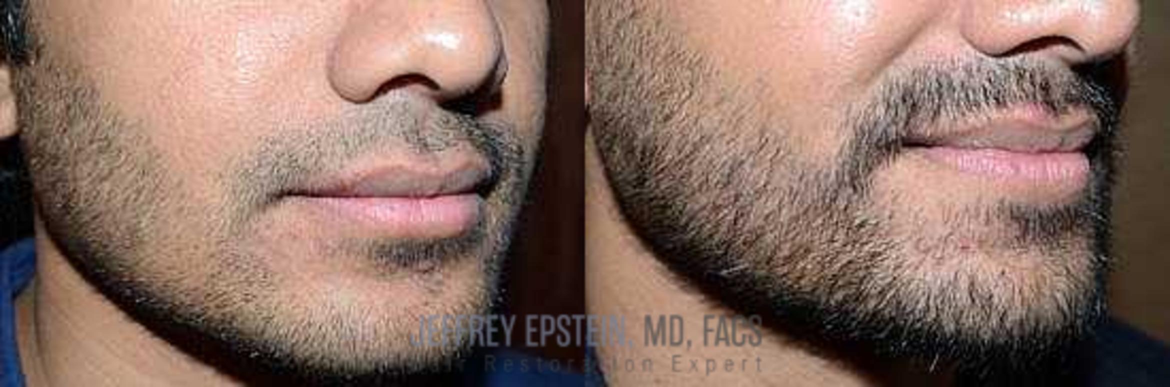 Before & After Beard Transplant Case 401 View 2 View in Miami, FL