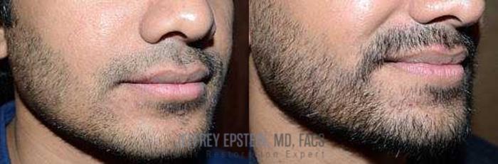 Before & After Beard Transplant Case 401 View 2 View in Miami, FL