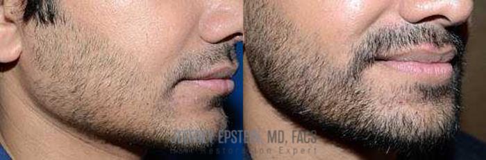 Before & After Beard Transplant Case 401 View 3 View in Miami, FL