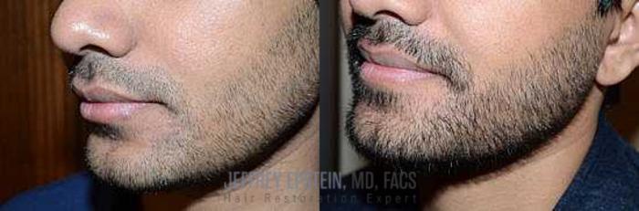 Before & After Beard Transplant Case 401 View 4 View in Miami, FL