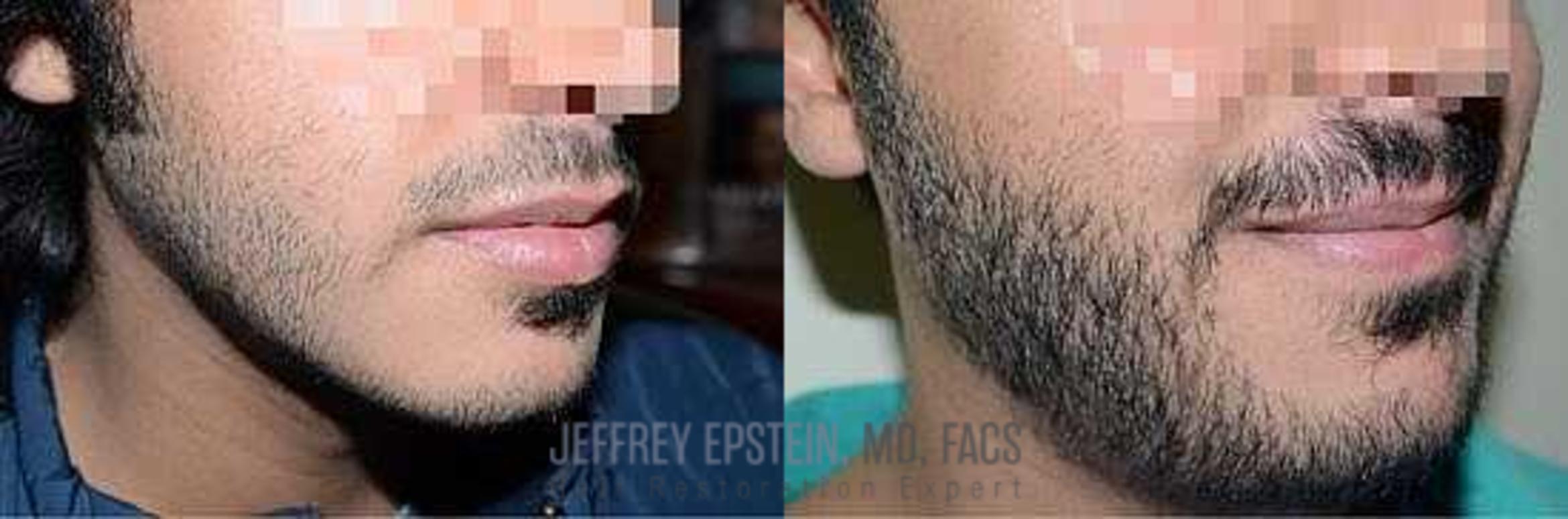 Before & After Beard Transplant Case 402 View 1 View in Miami, FL