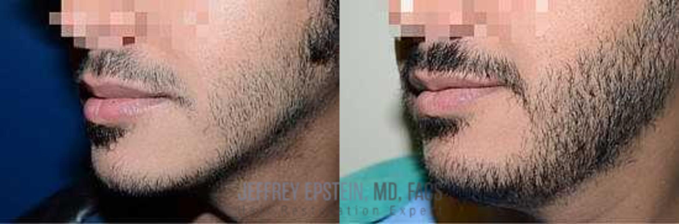 Before & After Beard Transplant Case 402 View 2 View in Miami, FL