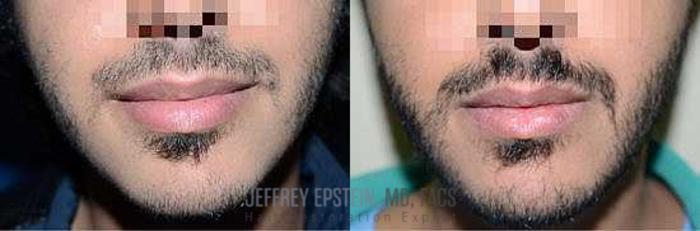 Before & After Beard Transplant Case 402 View 3 View in Miami, FL
