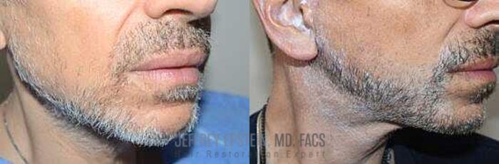 Before & After Beard Transplant Case 403 View 2 View in Miami, FL