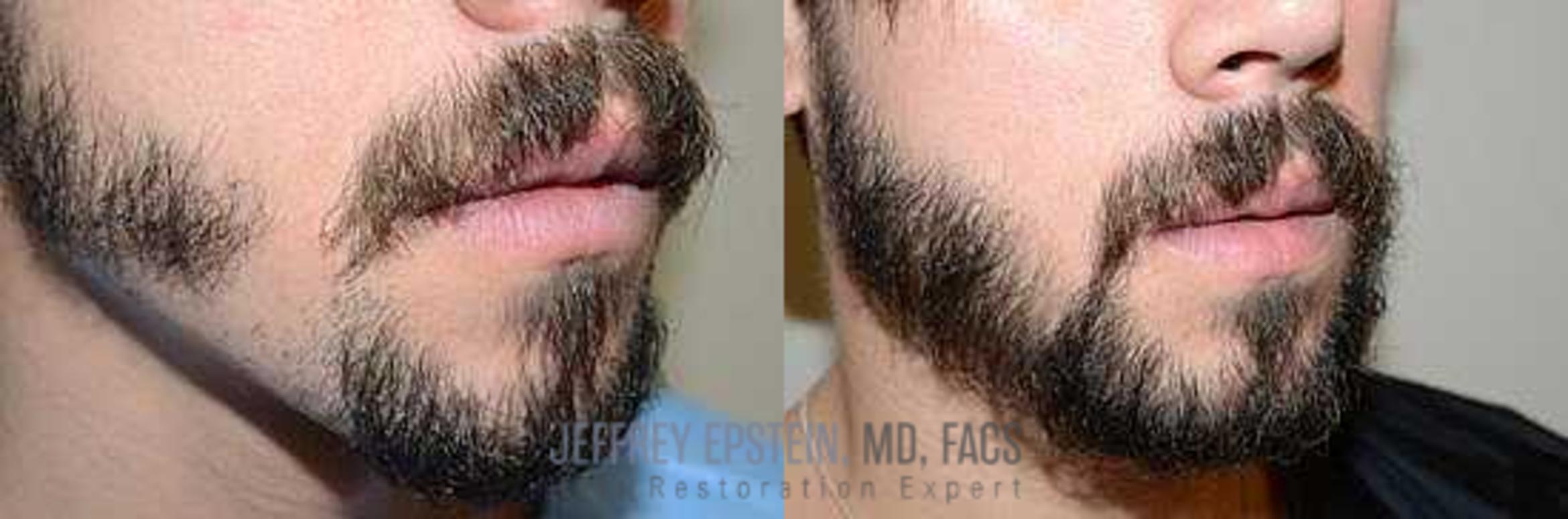 Before & After Beard Transplant Case 404 View 1 View in Miami, FL