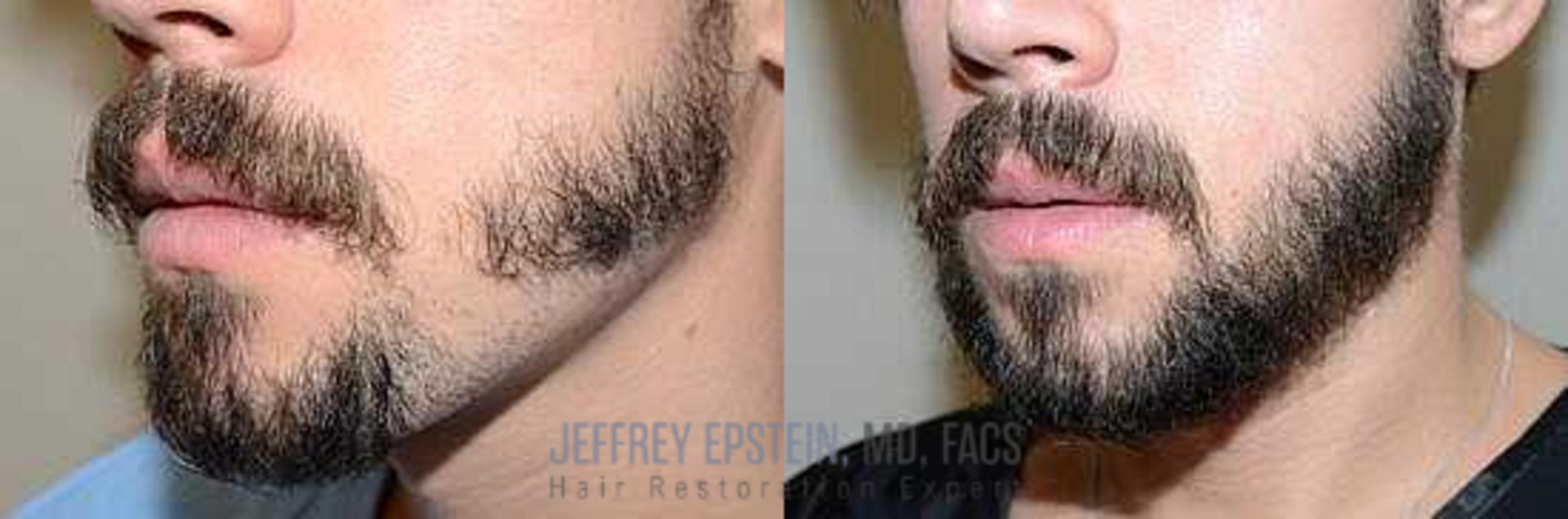 Before & After Beard Transplant Case 404 View 2 View in Miami, FL