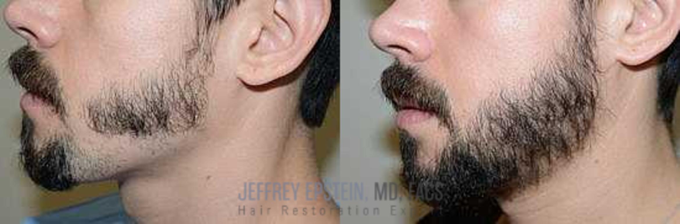 Before & After Beard Transplant Case 404 View 3 View in Miami, FL