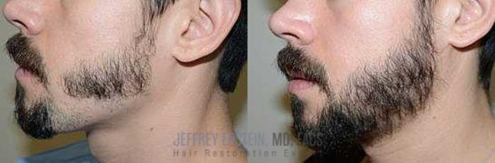 Before & After Beard Transplant Case 404 View 3 View in Miami, FL
