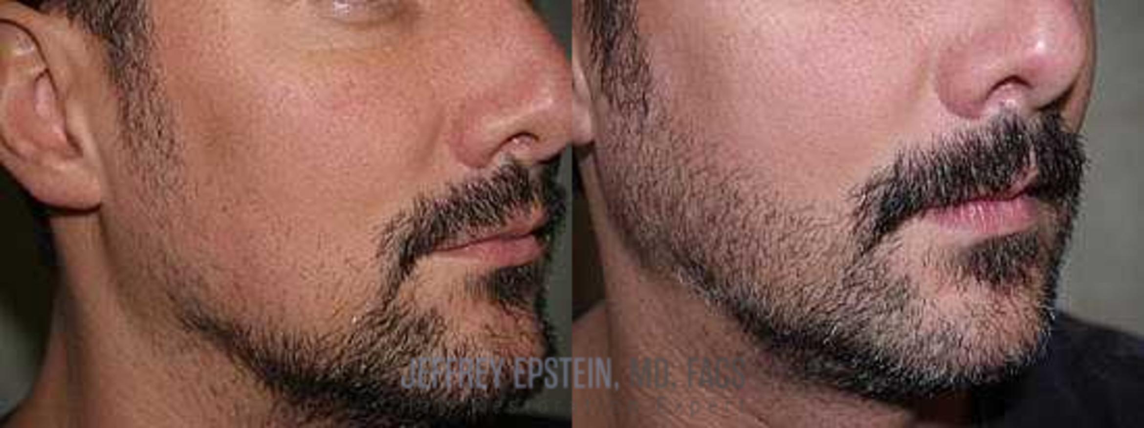 Before & After Beard Transplant Case 405 View 1 View in Miami, FL