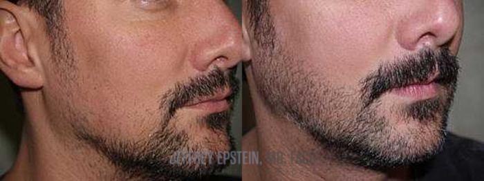 Before & After Beard Transplant Case 405 View 1 View in Miami, FL