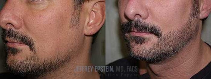 Before & After Beard Transplant Case 405 View 2 View in Miami, FL