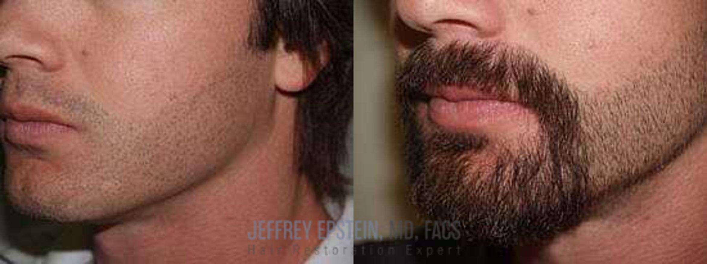 Before & After Beard Transplant Case 406 View 1 View in Miami, FL