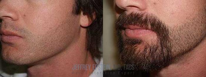 Before & After Beard Transplant Case 406 View 1 View in Miami, FL