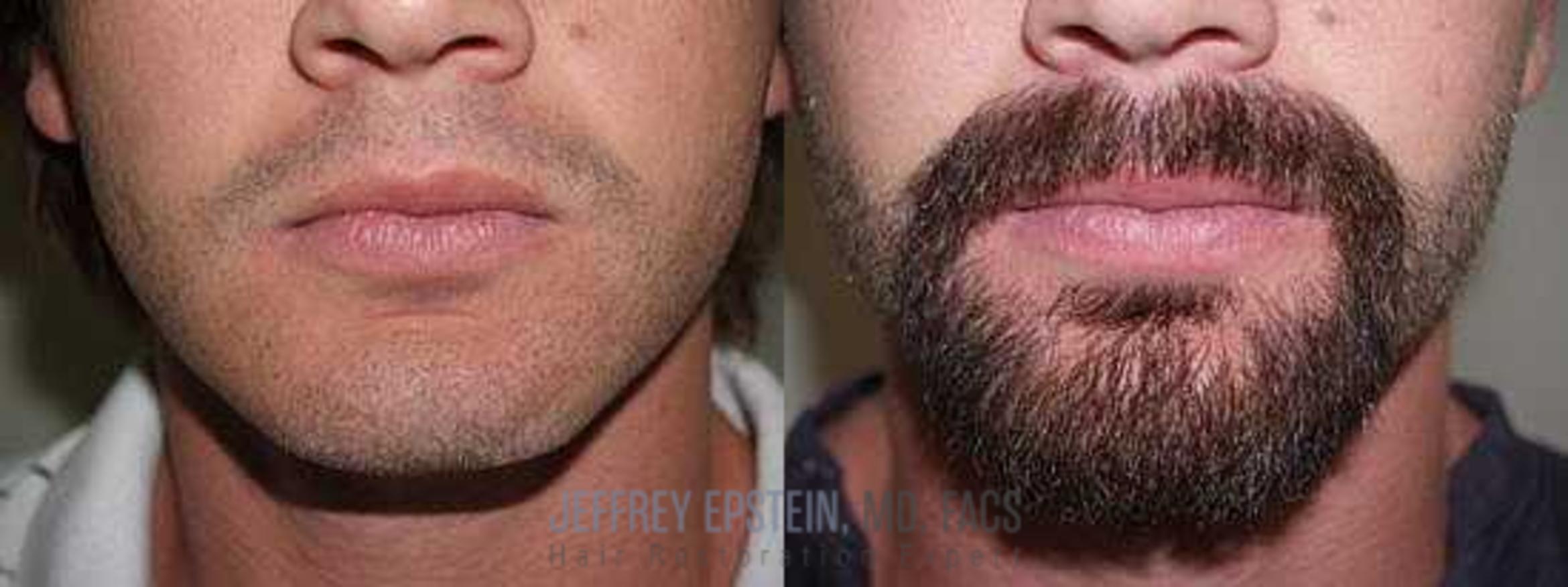 Before & After Beard Transplant Case 406 View 2 View in Miami, FL
