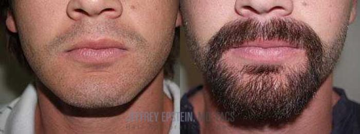 Before & After Beard Transplant Case 406 View 2 View in Miami, FL
