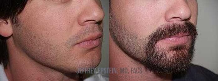 Before & After Beard Transplant Case 406 View 3 View in Miami, FL