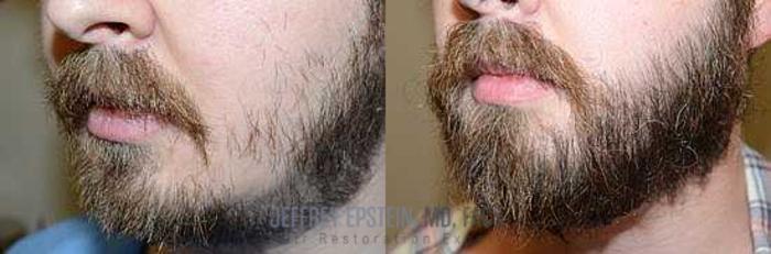 Before & After Beard Transplant Case 407 View 1 View in Miami, FL