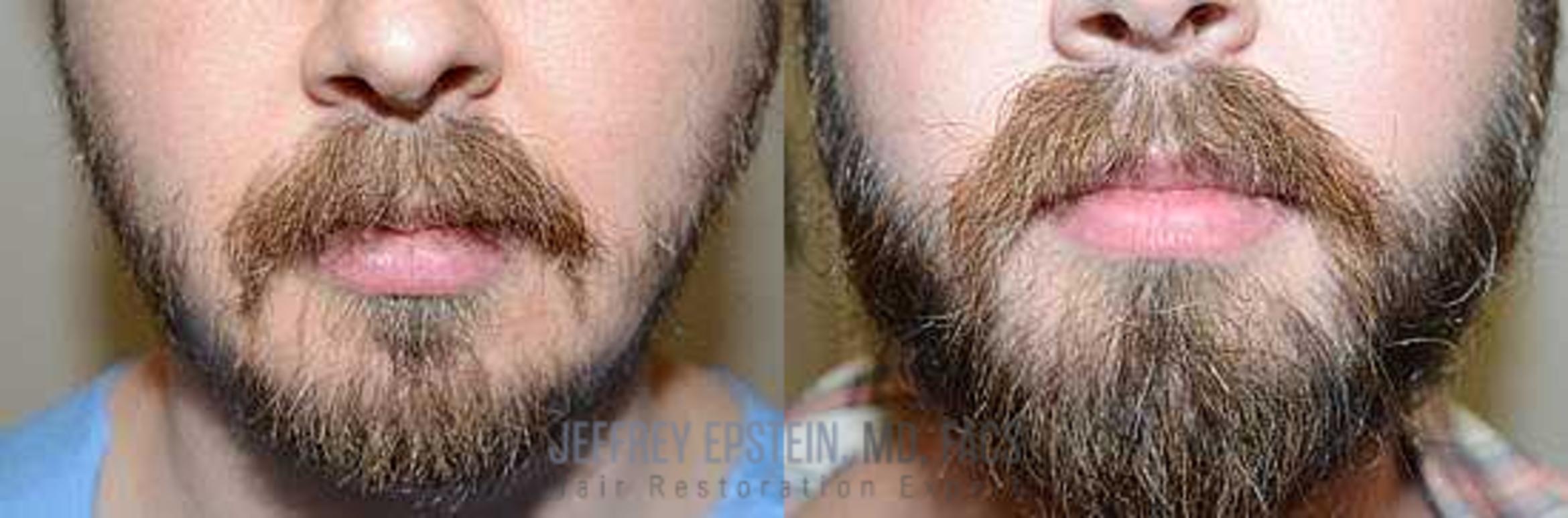 Before & After Beard Transplant Case 407 View 2 View in Miami, FL
