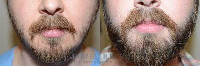Before & After Beard Transplant Case 407 View 2 View in Miami, FL