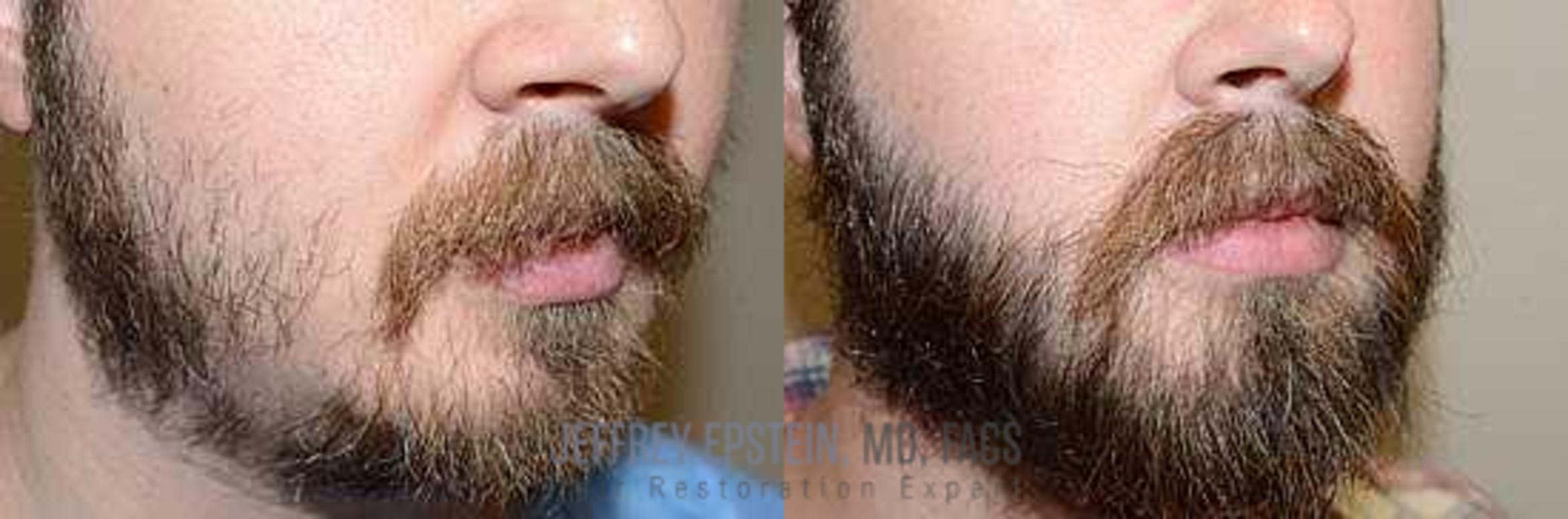 Before & After Beard Transplant Case 407 View 3 View in Miami, FL