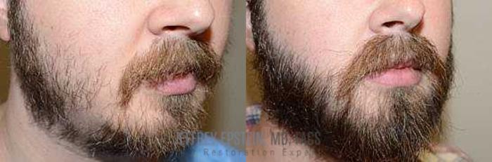 Before & After Beard Transplant Case 407 View 3 View in Miami, FL