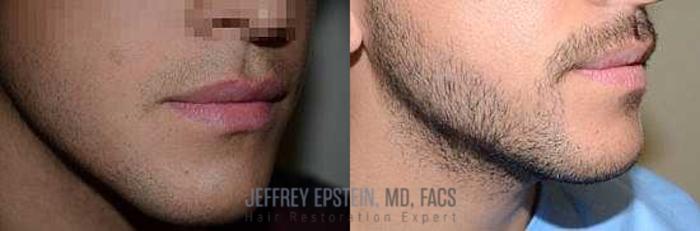 Before & After Beard Transplant Case 409 View 1 View in Miami, FL