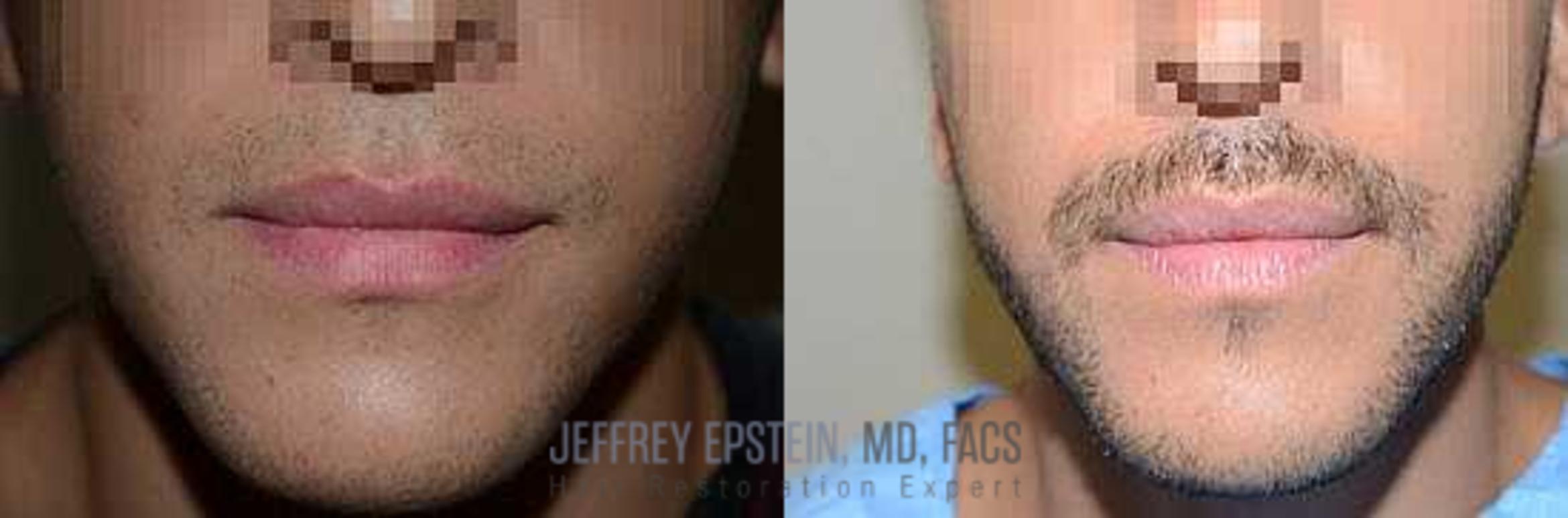 Before & After Beard Transplant Case 409 View 2 View in Miami, FL