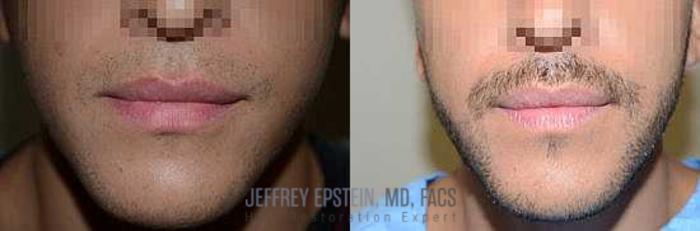 Before & After Beard Transplant Case 409 View 2 View in Miami, FL