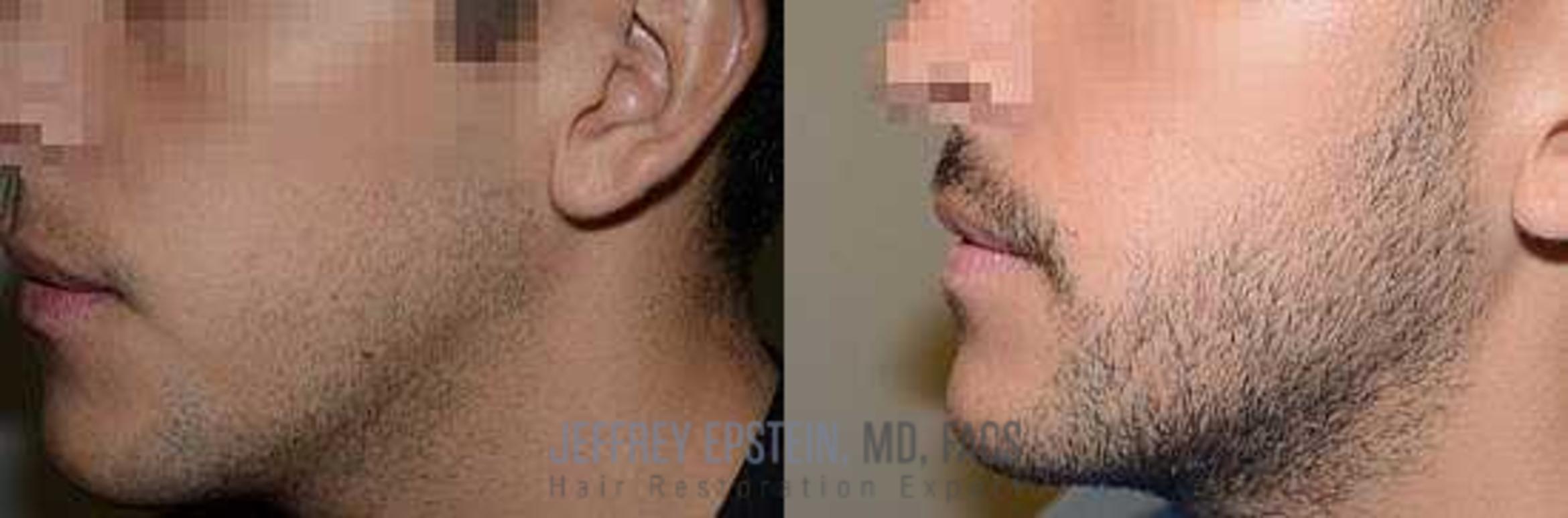 Before & After Beard Transplant Case 409 View 3 View in Miami, FL