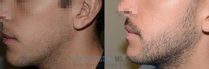 Before & After Beard Transplant Case 409 View 3 View in Miami, FL