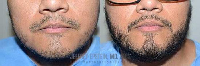 Before & After Beard Transplant Case 410 View 1 View in Miami, FL