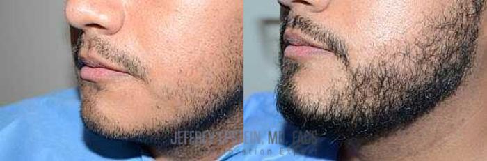 Before & After Beard Transplant Case 410 View 2 View in Miami, FL