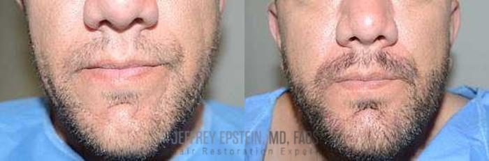 Before & After Beard Transplant Case 411 View 1 View in Miami, FL