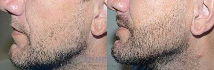 Before & After Beard Transplant Case 411 View 2 View in Miami, FL