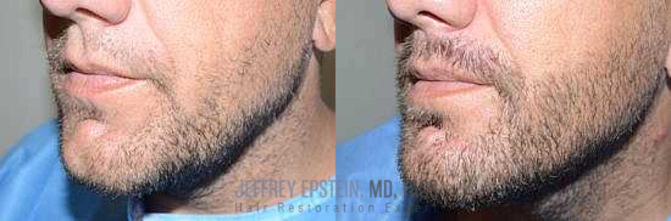 Before & After Beard Transplant Case 411 View 3 View in Miami, FL