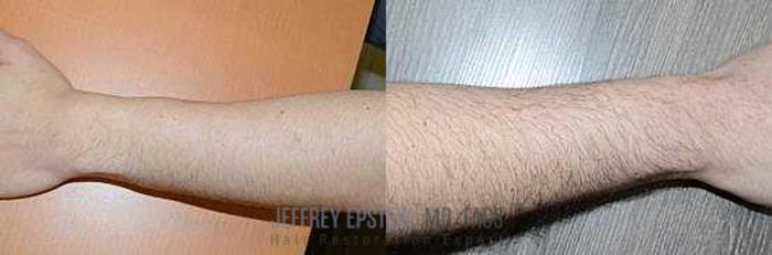 Before & After Body Hair Transplant (BHT) Case 357 View 1 View in Miami, FL
