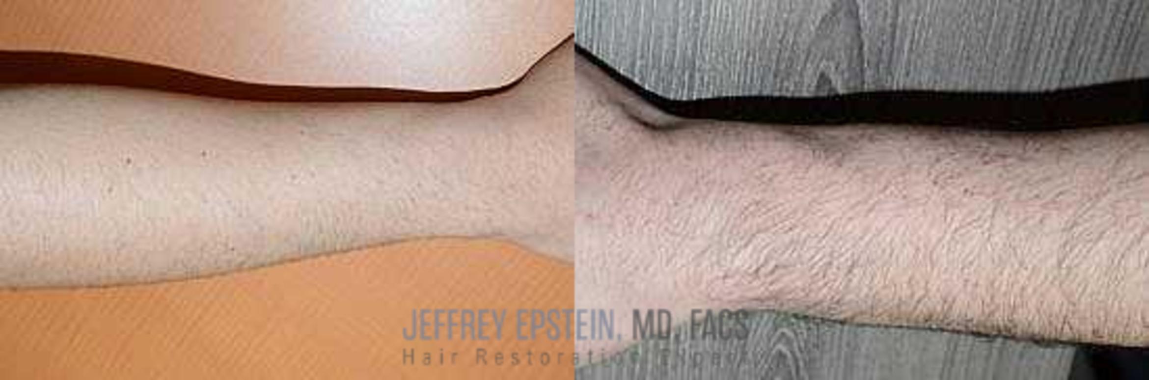 Before & After Body Hair Transplant (BHT) Case 357 View 2 View in Miami, FL