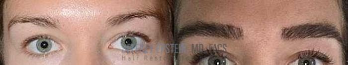 Before & After Eyebrow Transplant Case 170 View 1 View in Miami, FL